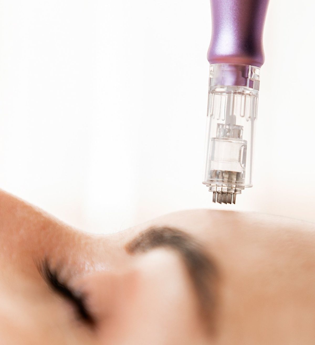 Microneedling Dermapen | Rejuvenecimiento Facial